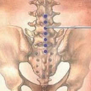spondiloza-lombara