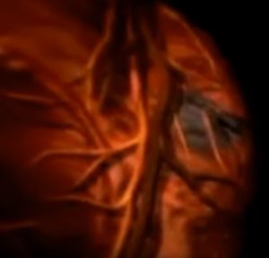 cardiopatia-ischemica