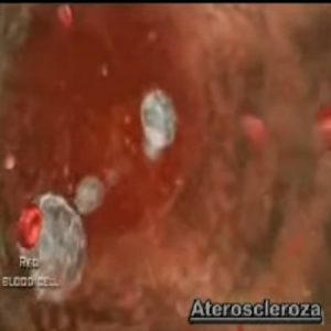 ateroscleroza
