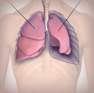 pneumotorax
