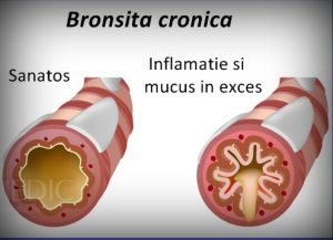 traheobronsita-acuta