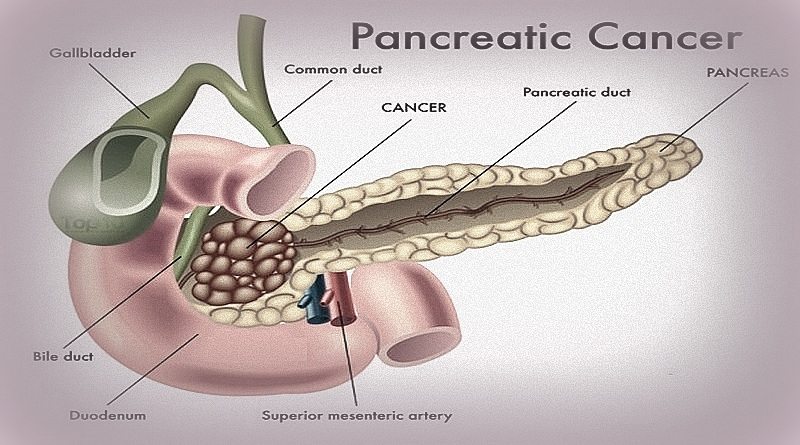 cancer-pancreas