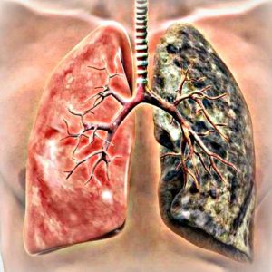 cancerul-bronhopulmonar