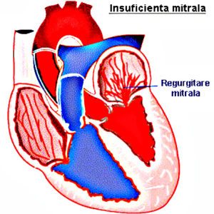 insuficienta-mitrala