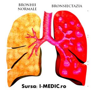 bronsiectazia