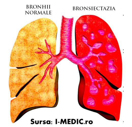bronsiectazia