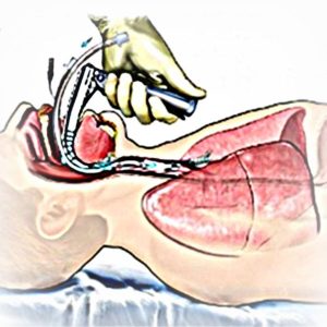 insuficienta-respiratorie-acuta-cronica
