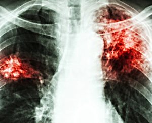 tuberculoza-pulmonara-tbc