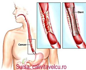 cancerul-esofagian