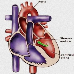 stenoza-aortica