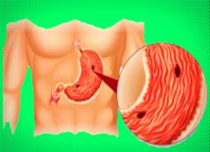 ulcerul-gastric-si-duodenal