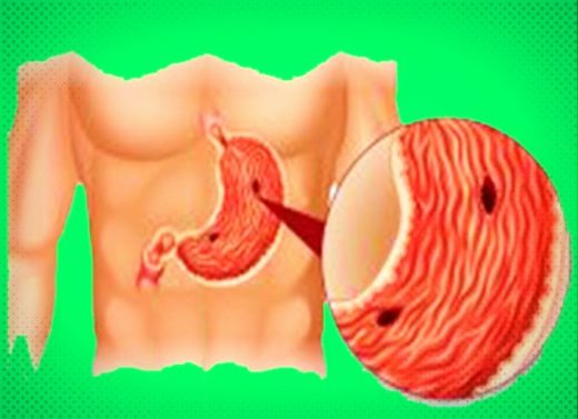 ulcerul-gastric-si-duodenal