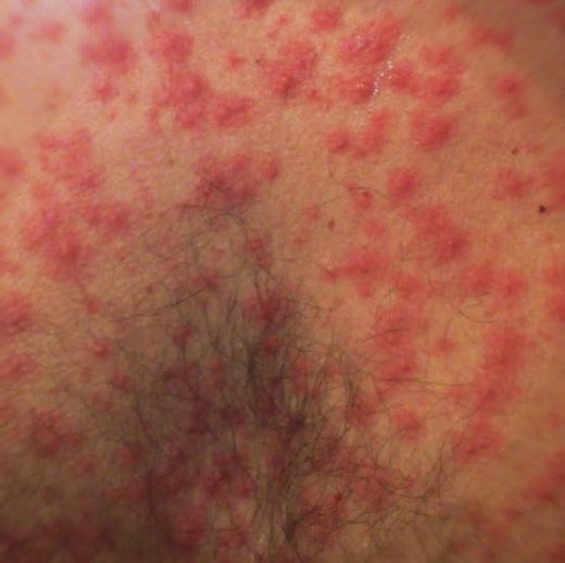 varicela-la-adult
