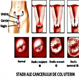 Cancerul-colului-uterin