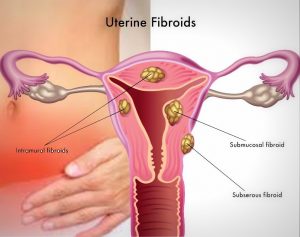Fibrom uterin