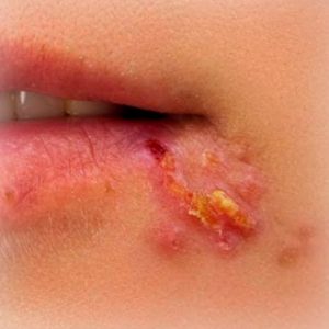 Herpes bucal (herpes de febră)