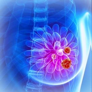 adenocarcinom-cancer-de-san