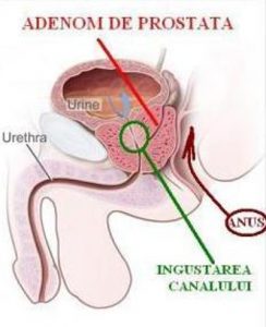 Adenomul prostatei