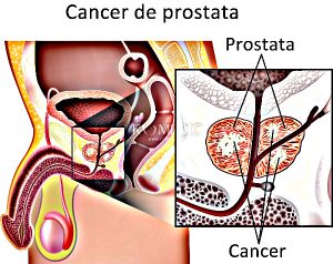 Cancerul prostatei