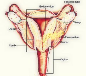 Cancerul corpului uterin