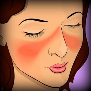 lupus