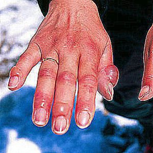 prim-ajutor-degeraturi