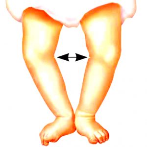 rahitism/osteomalacie