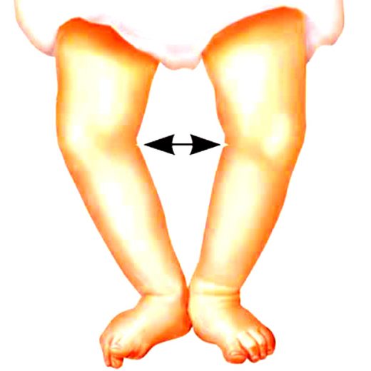 rahitism/osteomalacie
