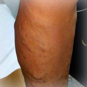 venele-varicoase-varicele
