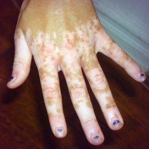 vitiligo