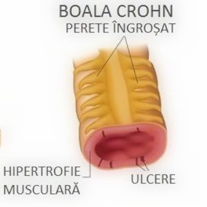 boala-crohn