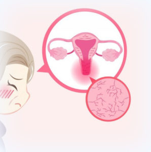 vaginită